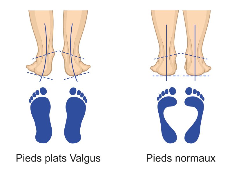 running-pied-plat